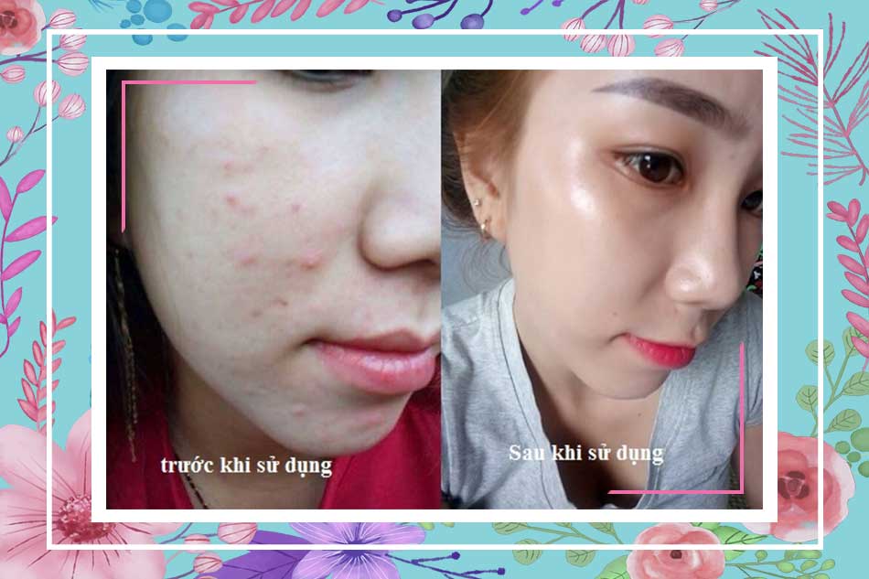 Review thuốc bắc trị mụn từ Webtretho