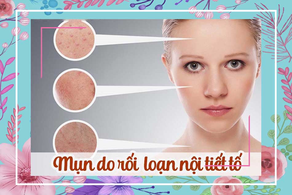 Uống thuốc bắc trị mụn nội tiết