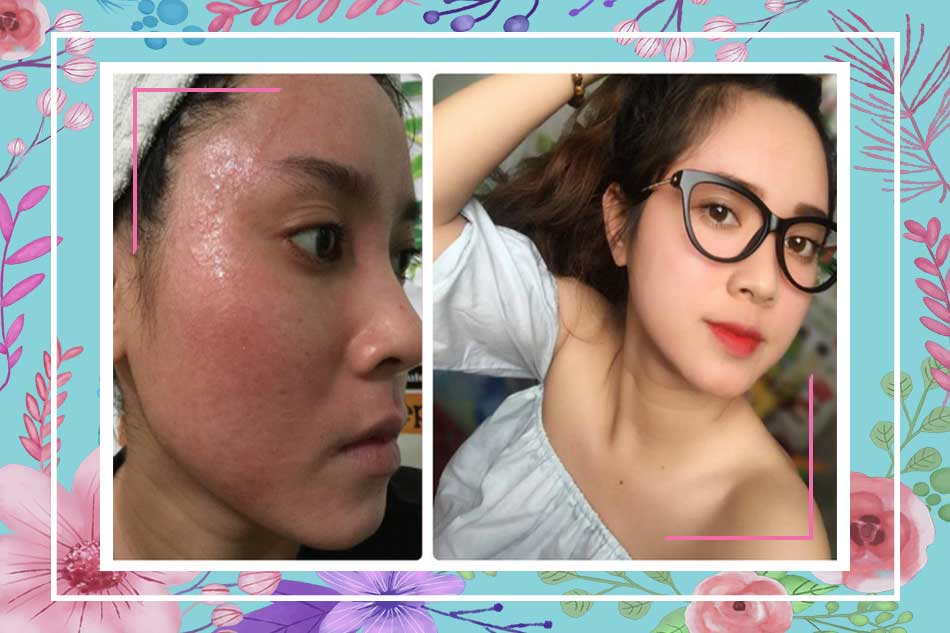 Xài thuốc bắc trị mụn có tốt không?