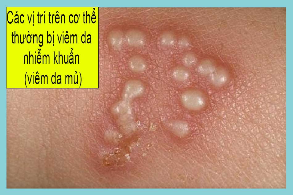 Các vị trí trên cơ thể thường bị viêm da nhiễm khuẩn (viêm da mủ)