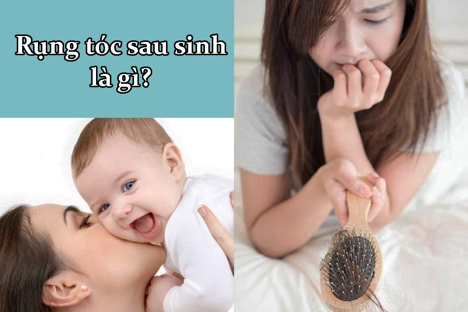 Rụng tóc sau sinh là gì?