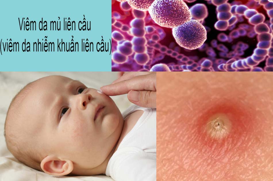 Viêm da mủ liên cầu (viêm da nhiễm khuẩn liên cầu)